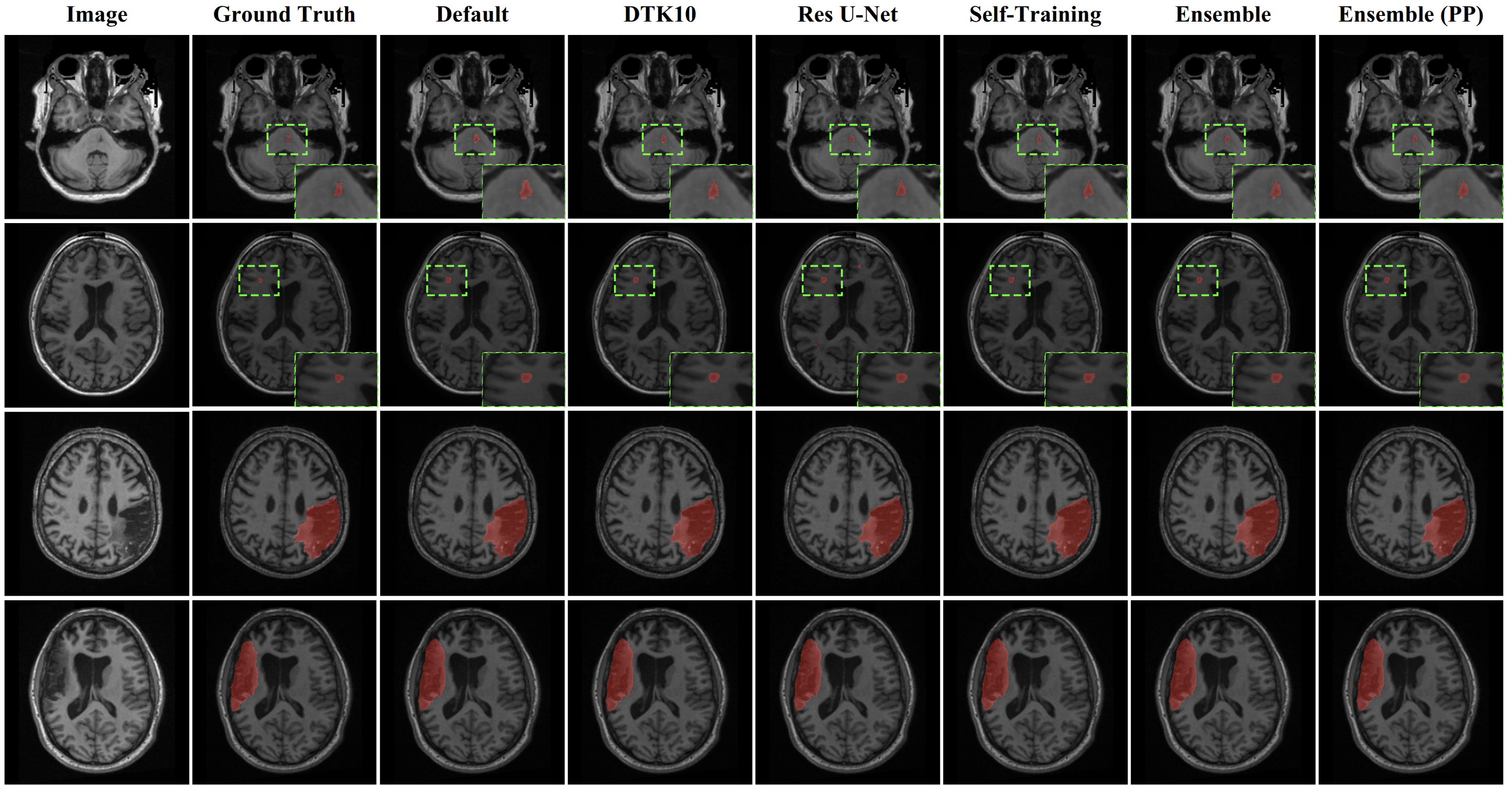 Stroke Lesion Segmentation